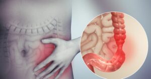 Cause e fattori di rischio della sindrome dell’intestino irritabile