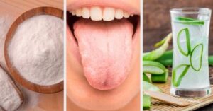 Potrai sbarazzarti della lingua bianca con questi 6 rimedi naturali