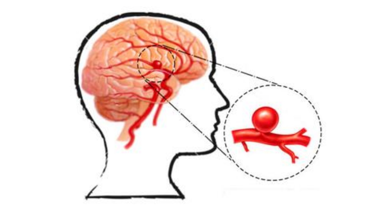 aneurisma cerebrale