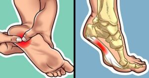 Cosa fare se ti fa male il tallone al mattino o ogni volta che ti alzi