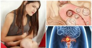 5 cose sui fibromi uterini che ogni donna dovrebbe conoscere