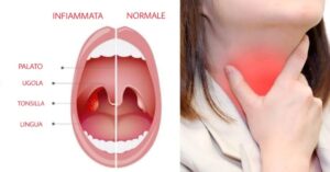Sbarazzati di tonsillite e mal di gola con questo rapido rimedio casalingo