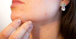 Trucco per coprire l’acne, è pericoloso? Come scegliere