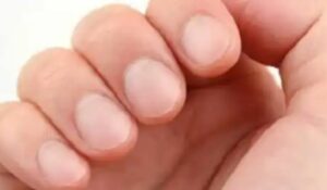 8 Segnali di pericolo per la salute che le tue unghie potrebbero rivelare