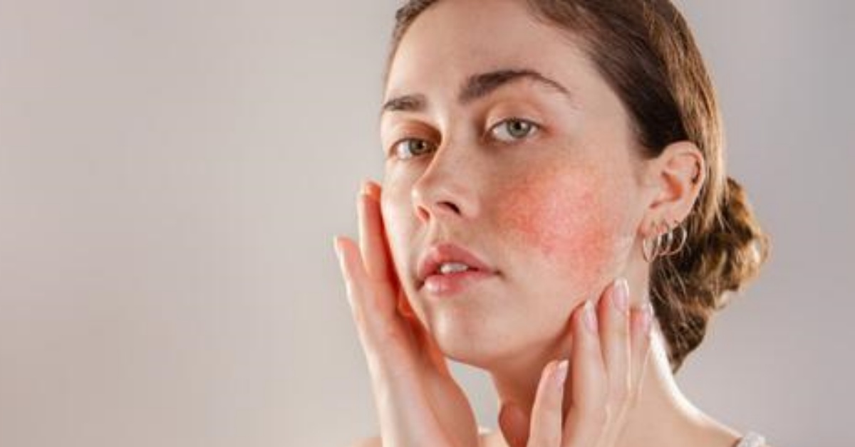 viso con rosacea