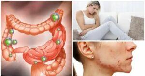 6 problemi che ti affliggono quando i batteri intestinali sono fuori controllo