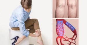 Come riconoscere i sintomi di una trombosi venosa alle gambe
