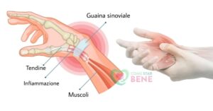 Tenosinovite, che dolore! Come risolvere il problema