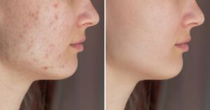 Come attenuare le cicatrici causate dall’acne: 3 rimedi naturali
