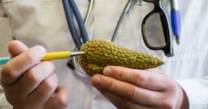 Come una patologia causata dal colesterolo alto può essere un segnale di cancro al pancreas