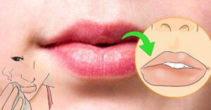 Cancro al labbro: cause, sintomi e trattamenti
