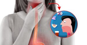 Le migliori soluzioni naturali per combattere i sintomi dell’esofagite