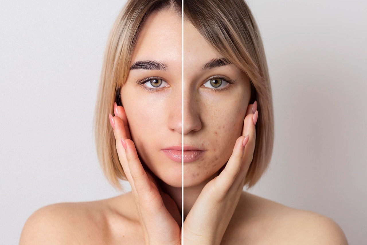 Maschera al pomodoro contro l'acne