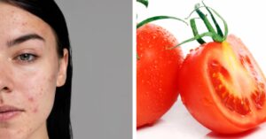 Strofina una fetta di pomodoro sul viso per 3 minuti: rimedio naturale contro l’acne