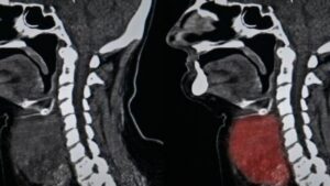 Come individuare per tempo il cancro alla testa o alla gola