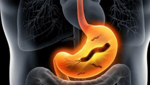 Helicobacter pylori: cos’è, complicazioni e trattamenti