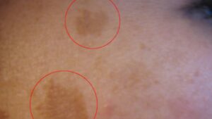 Trattamenti naturali per il melasma