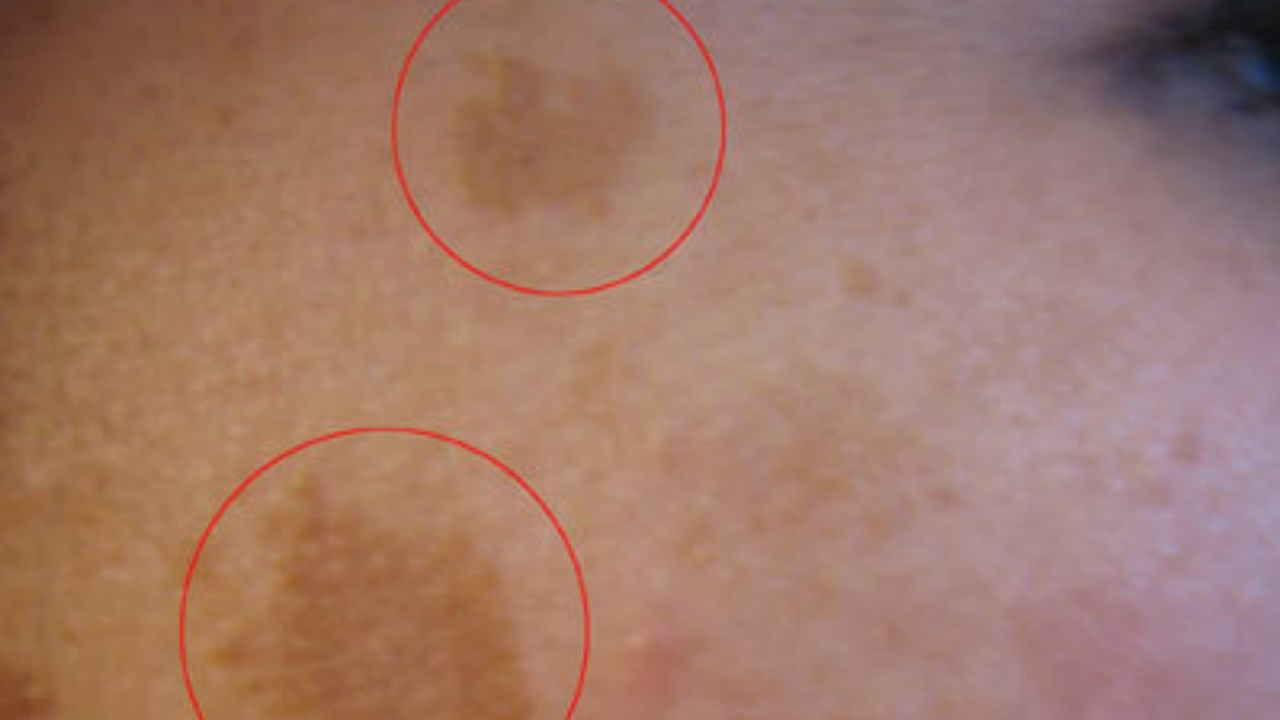 rimedi Melasma