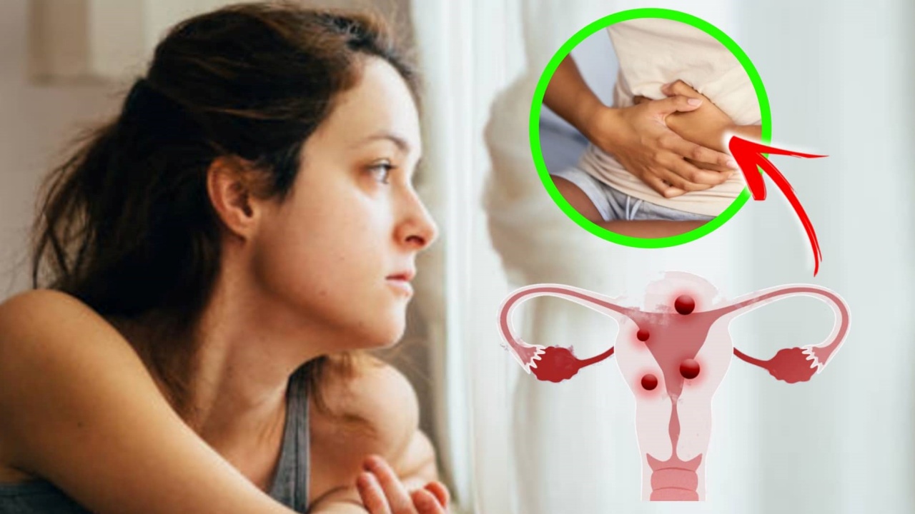 sintomi e cause mioma uterino