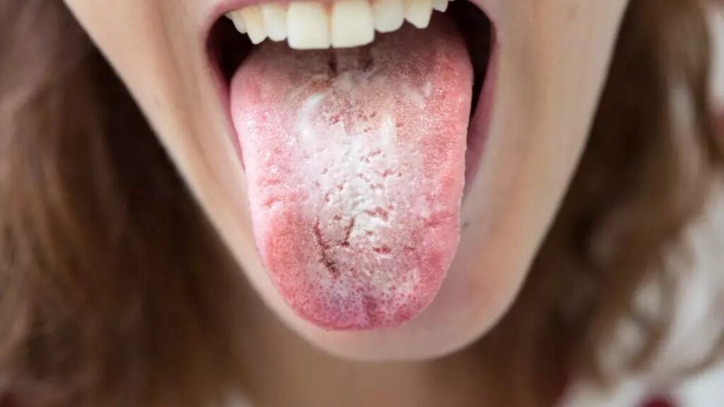 lingua con candida orale