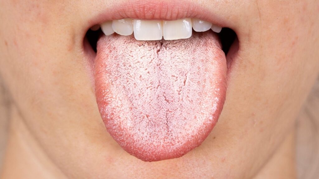 lingua con candida orale