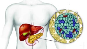 Sintomi e caratteristiche dell’insulinoma, il tumore del pancreas