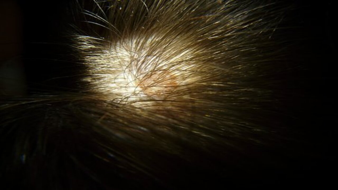 alopecia