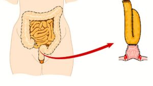 Che cos’è la malattia di Crohn e le modalità di cura