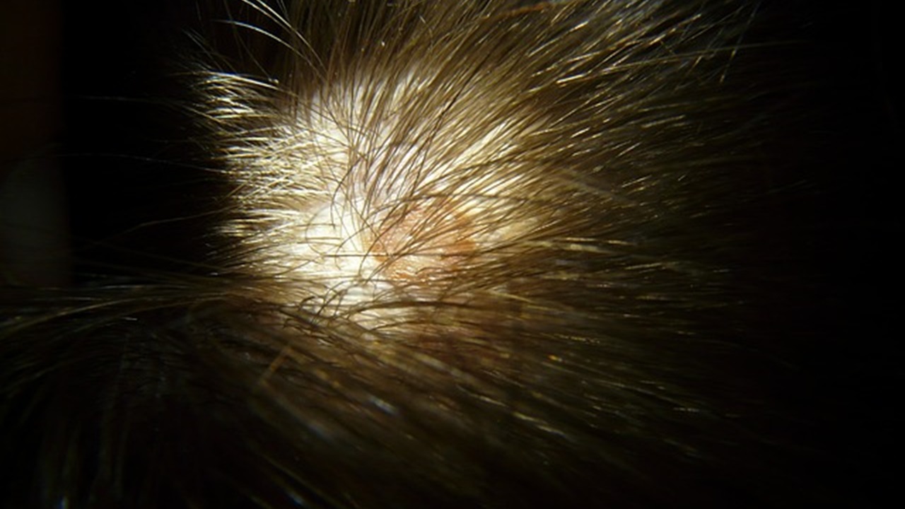 alopecia