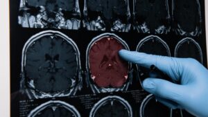 Le quattro malattie cerebrovascolari più diffuse che devi assolutamente conoscere