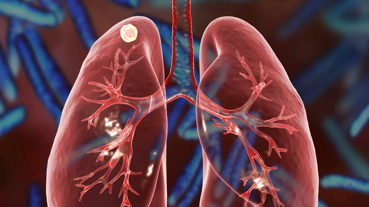 informazioni noduli polmonari