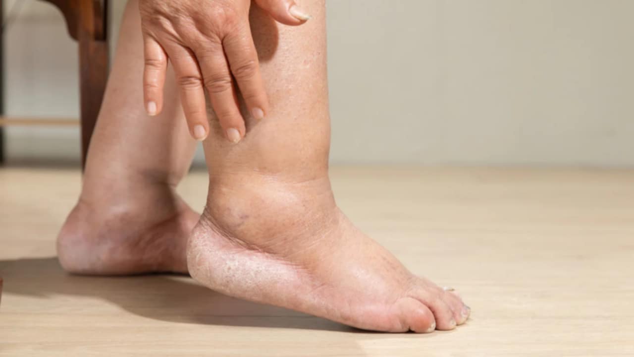 sintomi edema