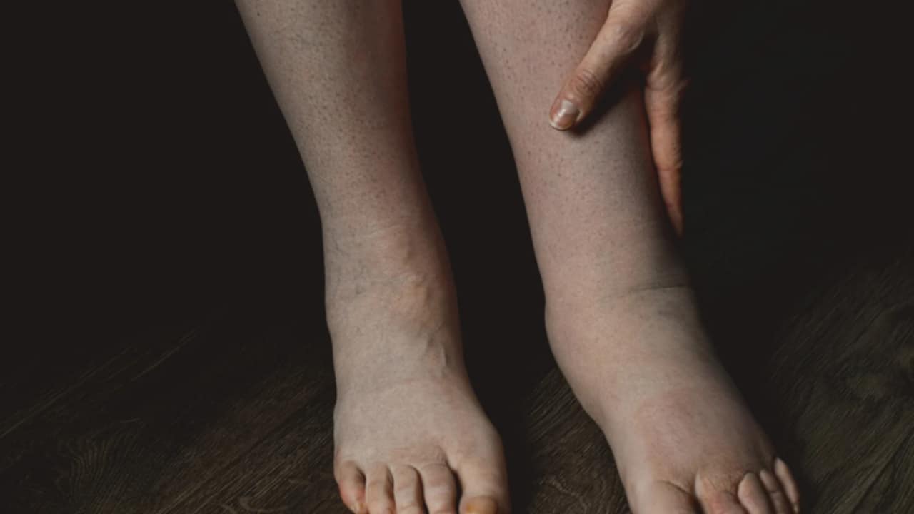 sintomi edema
