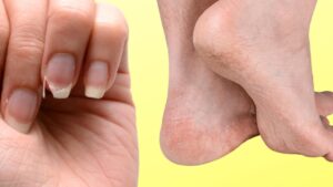 5 segnali d’allarme che mostrano che il tuo corpo è carente di nutrienti essenziali