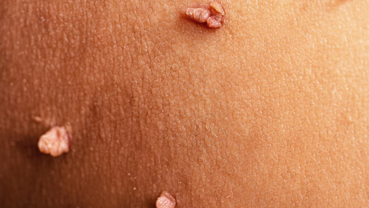 Fibromi penduli