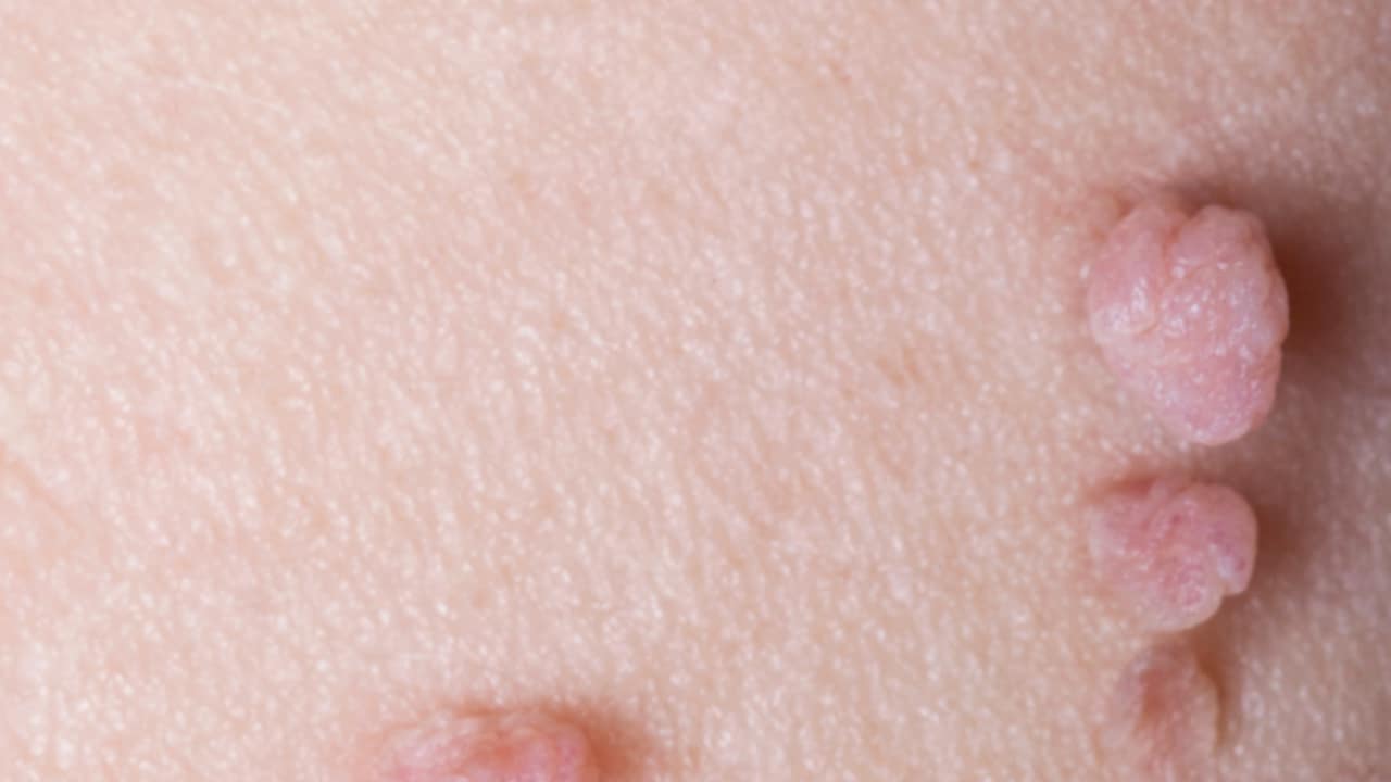 Fibromi penduli